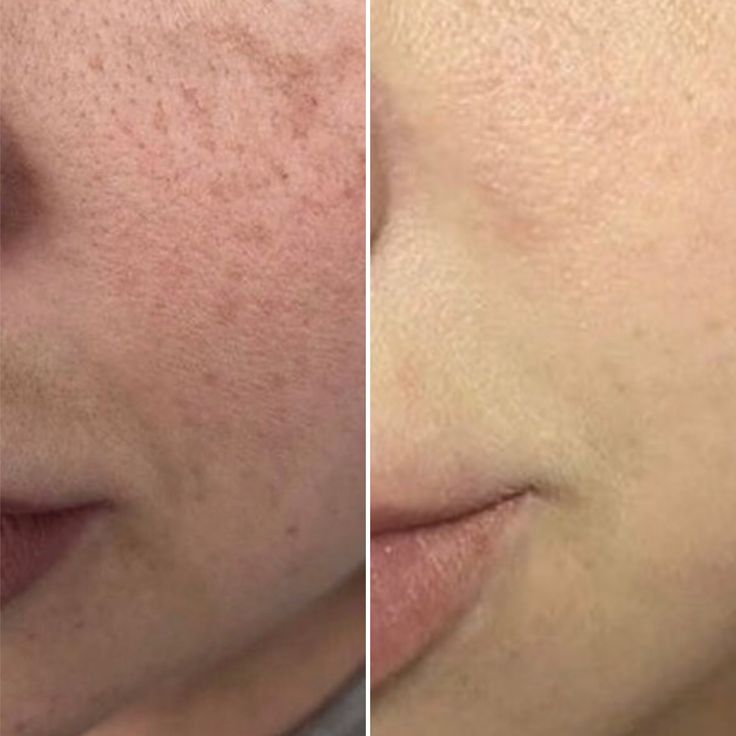 MYSaveskin™ Plasma pen