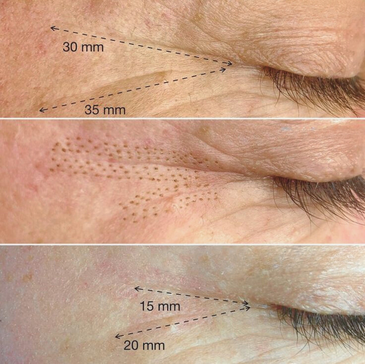 MYSaveskin™ Plasma pen