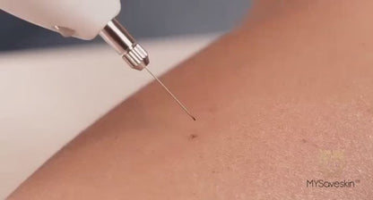 MYSaveskin™ Plasma pen - Migliora il 97,7% degli inestetismi della pelle a casa